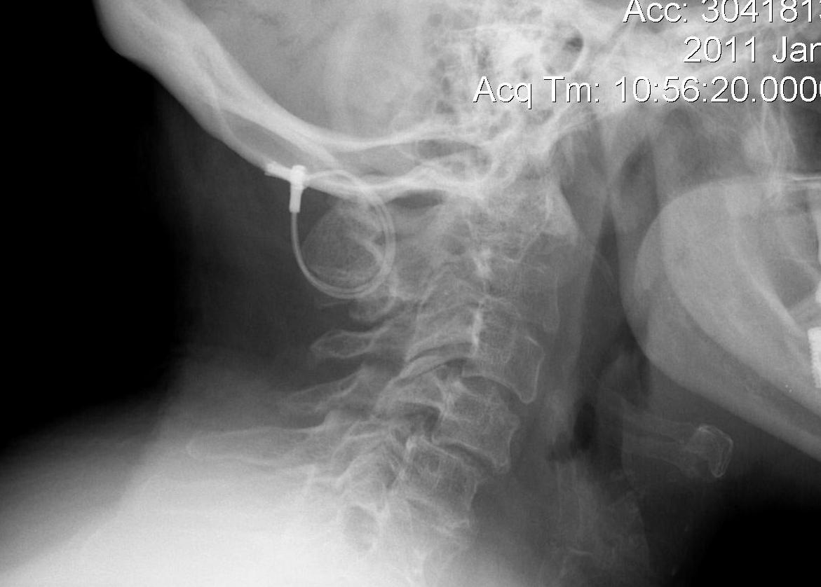 C1 C2 Posterior Spinous Process Wiring